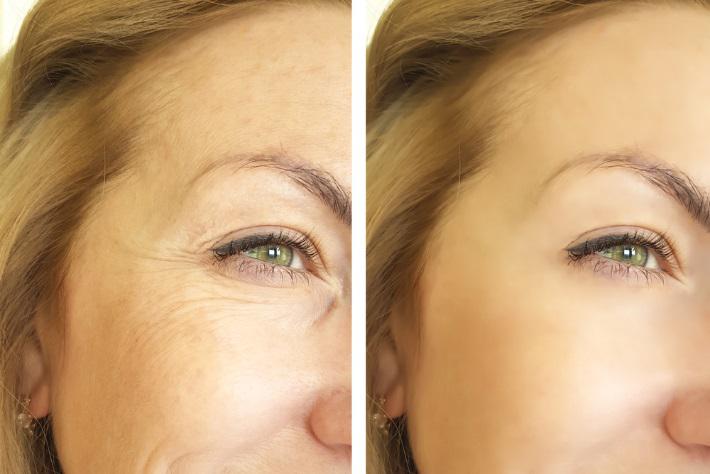 dermal fillers